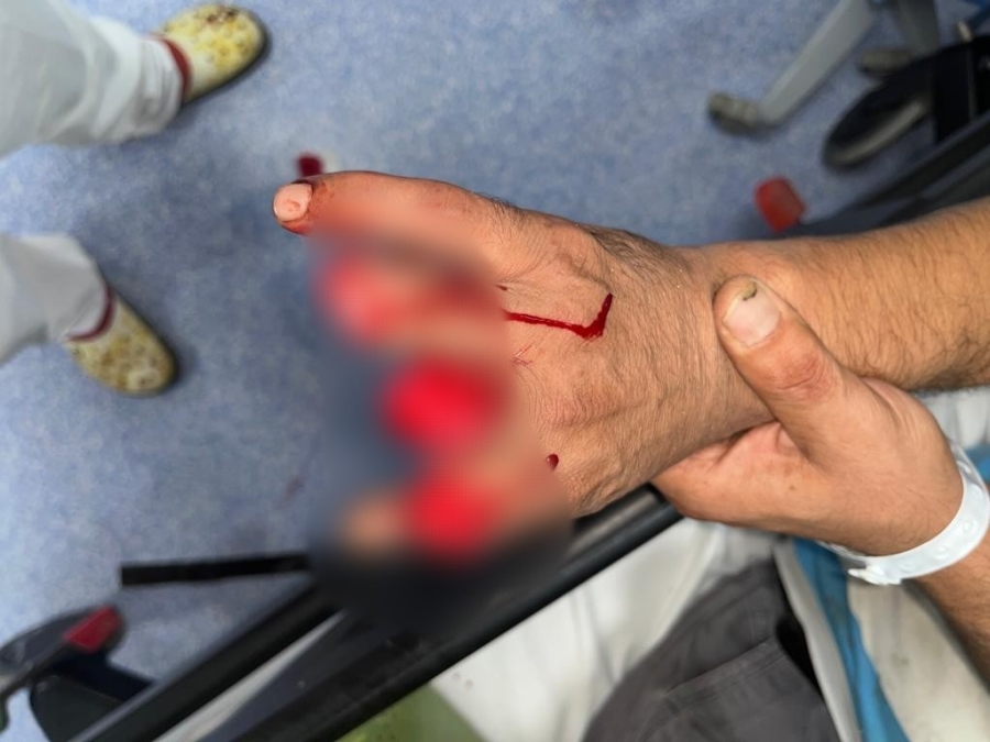 Kopan parmaklarıyla hastaneye koştu